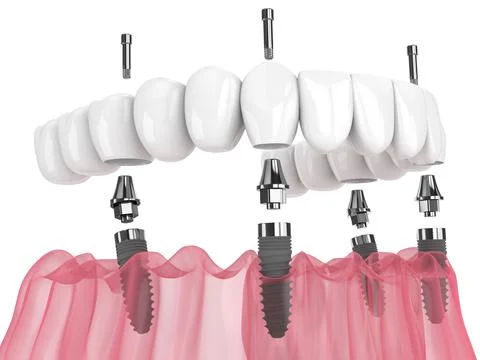 Mandibular prosthesis all on 4 system supported by implants Stock Illustration