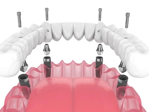 Mandibular prosthesis all on 4 system supported by implants Stock Illustration