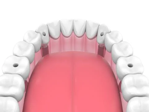 Mandibular prosthesis all on 4 system supported by implants Stock Illustration