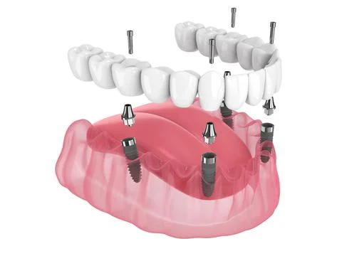 Mandibular prosthesis all on 4 system supported by implants Illustrazione stock