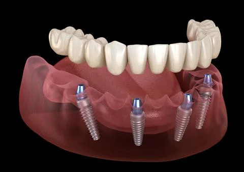Mandibular prosthesis All on 4 system supported by implants. Medically accura Stock Illustration