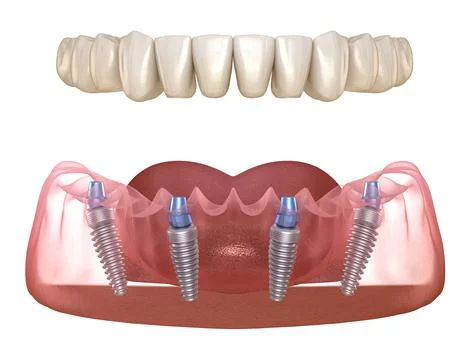 Mandibular prosthesis All on 4 system supported by implants. Medically accura Stock Illustration
