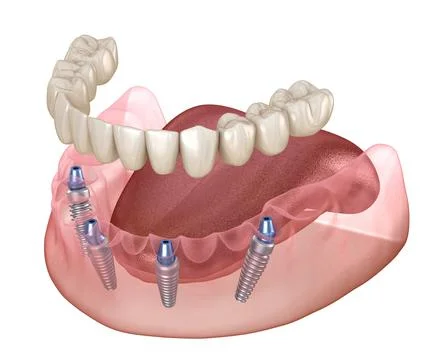 Mandibular prosthesis All on 4 system supported by implants. Medically accura Stock Illustration