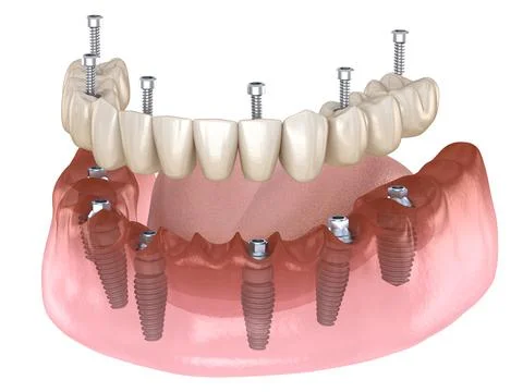 Mandibular prosthesis All on 4 system supported by implants, screw fixation. Stock Illustration