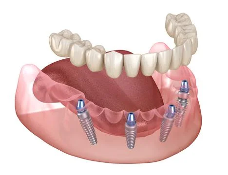 Mandibular prosthesis All on 4 system supported by implants. Illustrazione stock