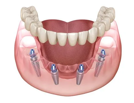 Mandibular prosthesis All on 4 system supported by implants. Stock Illustration