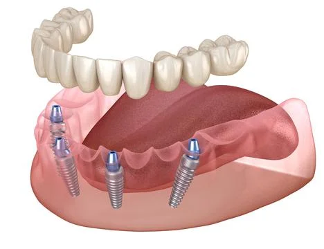 Mandibular prosthesis All on 4 system supported by implants. Stock Illustration