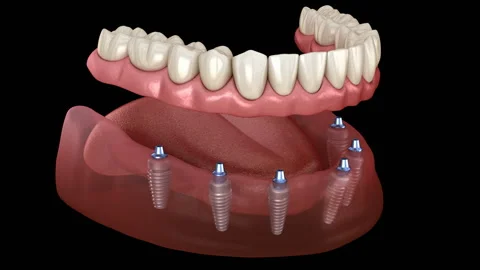 Mandibular prosthesis All on 6 system supported by implants Stock Footage 100821182