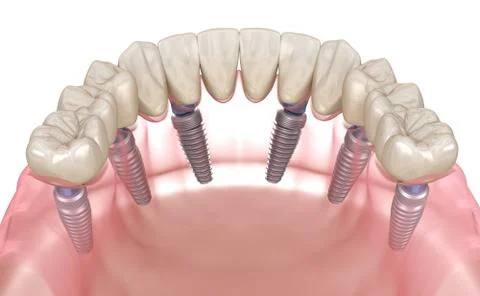Mandibular prosthesis All on 6 system supported by implants. Medically accura Illustrazione stock