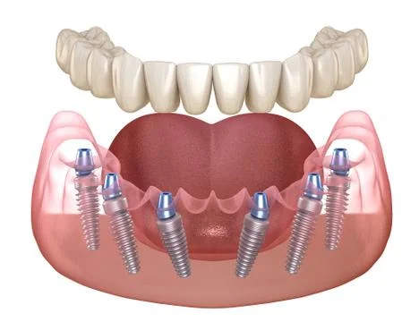 Mandibular prosthesis All on 6 system supported by implants. Medically accura Stock Illustration