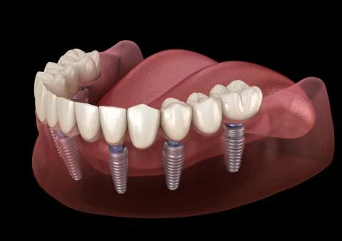 Mandibular prosthesis All on 6 system supported by implants. Medically accura Stock Illustration