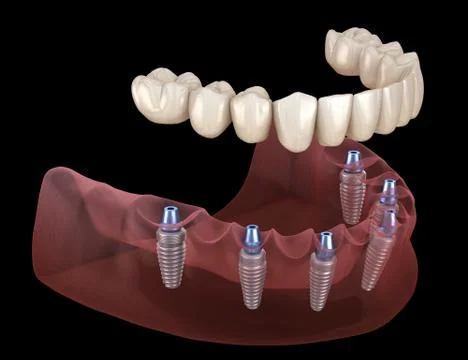 Mandibular prosthesis All on 6 system supported by implants. Medically accura Stock Illustration