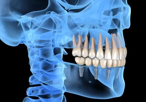 Mandibular prosthesis All on 6 system supported by implants. Medically accura Stock Illustration
