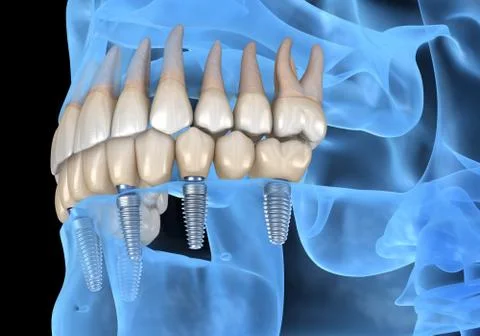 Mandibular prosthesis All on 6 system supported by implants. Medically accura 스톡 일러스트
