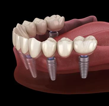 Mandibular prosthesis All on 6 system supported by implants. Medically accura Stock Illustration