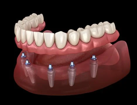 Mandibular prosthesis All on 6 system supported by implants. Medically accura Ilustração Stock