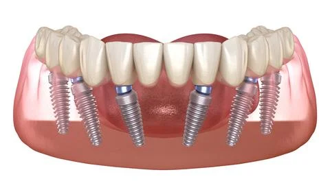 Mandibular prosthesis All on 6 system supported by implants. Medically accura Stock Illustration