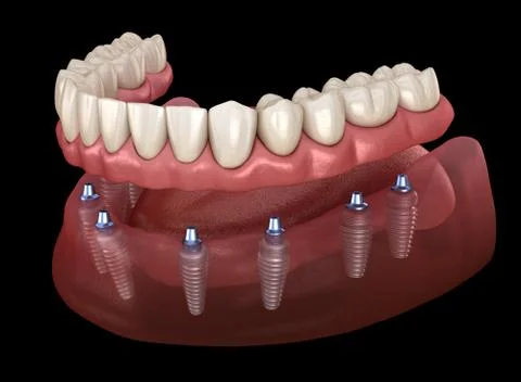 Mandibular prosthesis All on 8 system supported by implants. Medically accura Stock Illustration