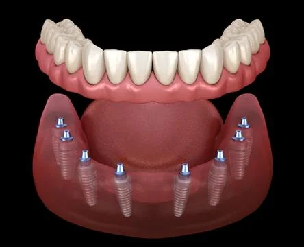 Mandibular prosthesis All on 8 system supported by implants. Medically accura Stock Illustration
