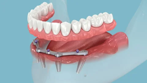 Mandibular prosthesis with gum All on 4 system supported by implants. Stock Footage 255700016