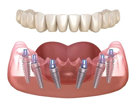 Mandibular prosthesis with gum All on 6 system supported by implants. Stock Illustration