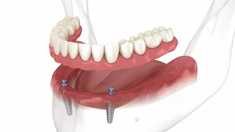 Mandibular removable prosthesis All on 2 system supported by implants Stock Footage 204139579