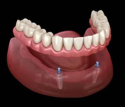 Mandibular removable prosthesis All on 2 system supported by implants with ba Stock Illustration