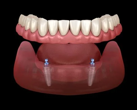 Mandibular removable prosthesis All on 2 system supported by implants with ba Illustrazione stock