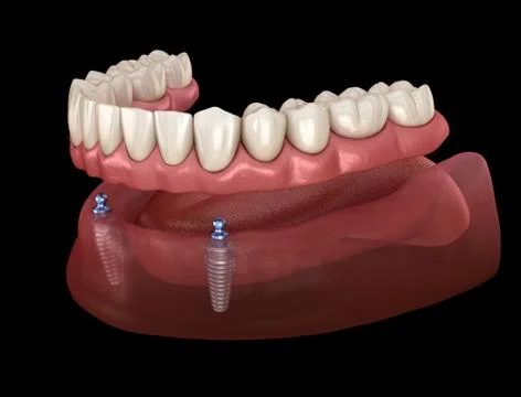 Mandibular removable prosthesis All on 2 system supported by implants with ba Stock Illustration