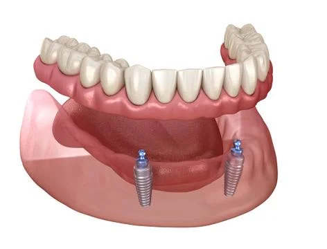 Mandibular removable prosthesis All on 2 system supported by implants with ba Stock Illustration