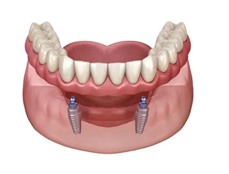 Mandibular removable prosthesis All on 2 system supported by implants with ba Stock Illustration