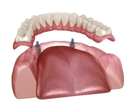 Mandibular removable prosthesis All on 2 system supported by implants with ba Illustrazione stock