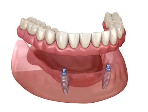 Mandibular removable prosthesis All on 2 system supported by implants with ba Stock Illustration