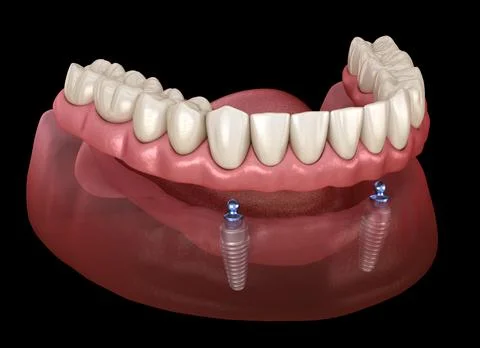 Mandibular removable prosthesis All on 2 system supported by implants with ba Stock Illustration