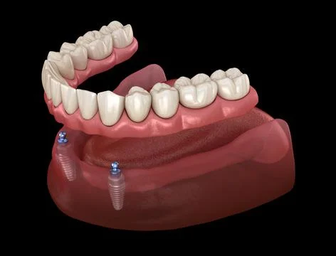 Mandibular removable prosthesis All on 2 system supported by implants with ba Stock Illustration