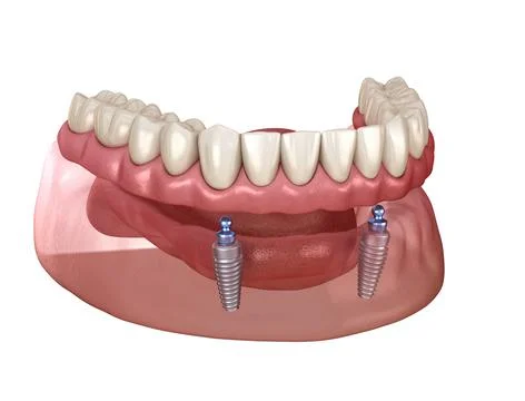 Mandibular removable prosthesis All on 2 system supported by implants with ba Stock Illustration