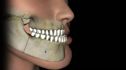 Mandibular setback surgery animation. 스톡 동영상 45995071