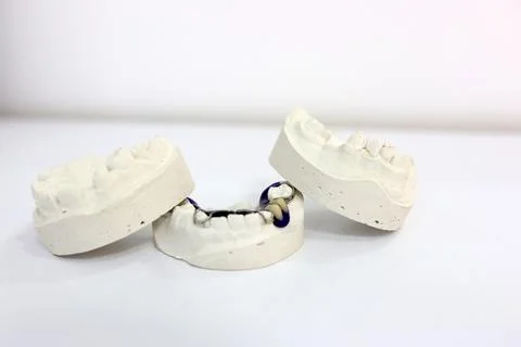 Mandibular teeth cast. Obtaining an impression of the dental arch for the p.. Stock Photos