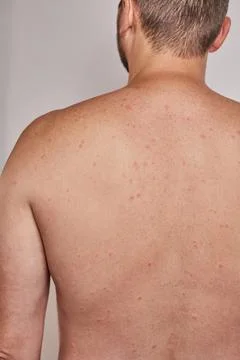 Man's back with acne, red spots, skin disease Stock Photos