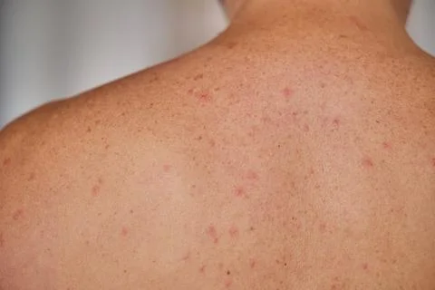Man's back with acne, red spots, skin disease Stock Photos