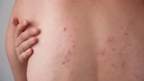 Man's back is covered in acne and pimples. Skin problems. Dermatology. Body care Stock Footage 136687200