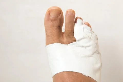 Mans bandaged up broken toe Stock Photos