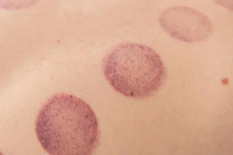 A man's bare back with several large, deep purple, oval-shaped bruises afte.. Fotos de archivo