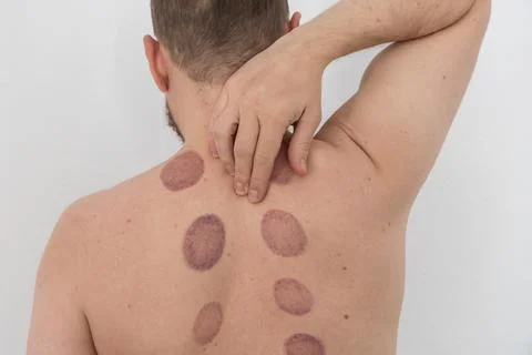 A man's bare back with several large, deep purple, oval-shaped bruises afte.. Stock Photos