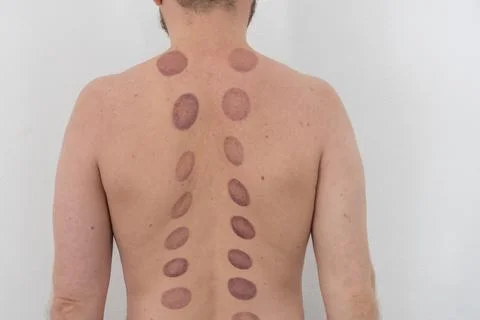 A man's bare back with several large, deep purple, oval-shaped bruises after  Stock-Fotos