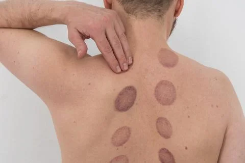 A man's bare back with several large, deep purple, oval-shaped bruises after  Stock Photos