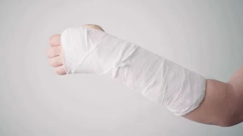 A man's broken arm in a white plaster bandage warms up his injured fingers close Stock Footage 132995764