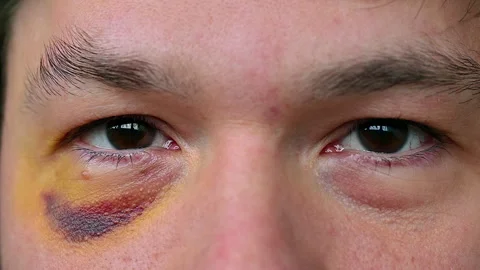 Man's face close-up with bruised eye after injury Stock Footage 263774355