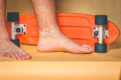 Man's feet with skin pigmentation problems on the ankle Stock Photos