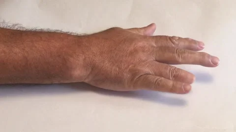 Mans hand after having part of third finger amputated  Stock Footage